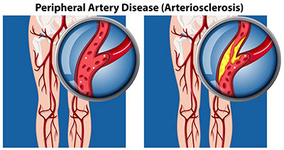 peripheral arthery disease