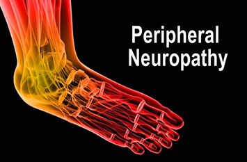 neuropathy