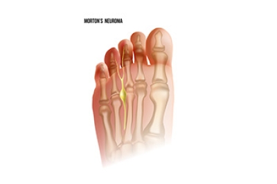 Causes of Nerve Pain in the Feet