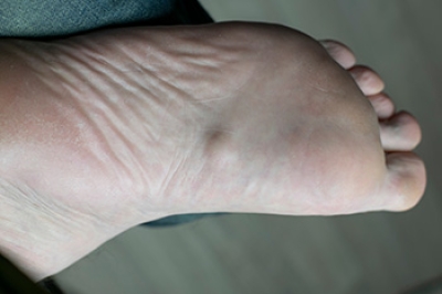 Plantar Fibroma Facts