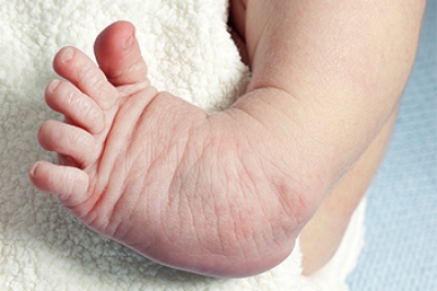 Understanding Clubfoot