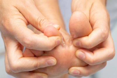 Symptoms and Relief Strategies for Athletes Foot