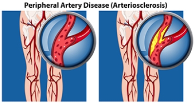 Finding Relief for Peripheral Artery Disease in the Feet